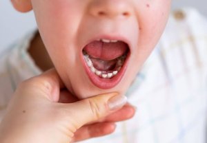 Carie dentaire chez l'enfant : Guide de pr&eacute;vention & traitement 