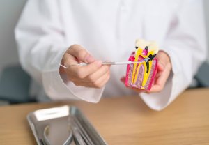 Combien coûte le traitement d’une carie dentaire au Québec ?