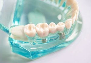 Combien de Temps Faut-il Pour s’Habituer à une Prothèse Dentaire ?