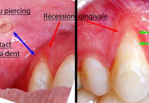 Oral piercings