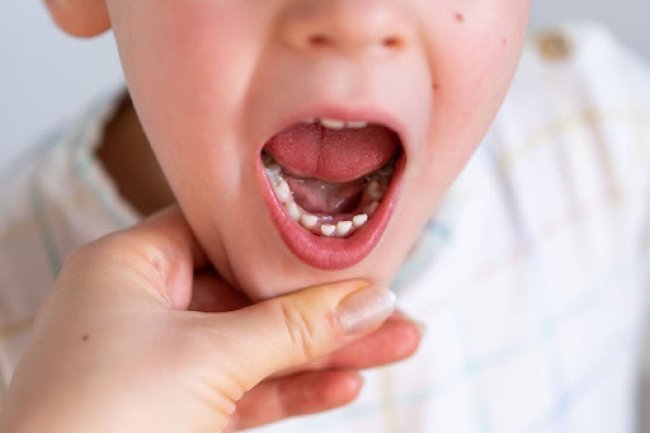 Carie dentaire chez l'enfant : Guide de prévention & traitement 
