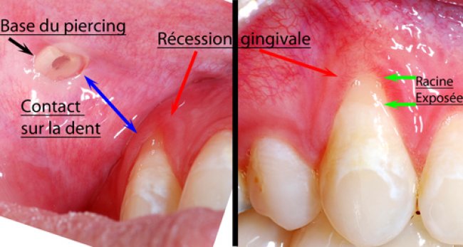 Oral piercings